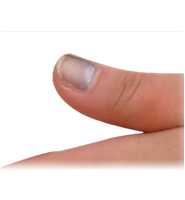 Fingernail Problems