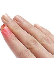 Fingertip Injuries/Amputations