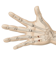 Hand Fractures
