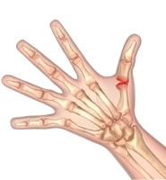 Arthritis of the Hand, Thumb and Wrist