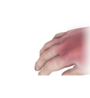 Reflex Sympathetic Dystrophy