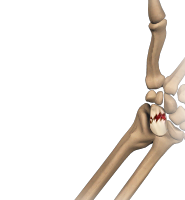 Scaphoid (wrist bone) Fracture