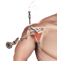 Arthroscopic Surgery