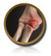 Scaphoid (wrist bone) Fracture