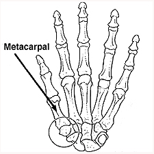 Arthritis – Hand & Wrist