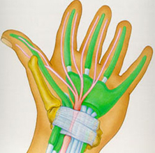 Carpel Tunnel Syndrome