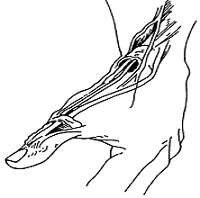 Dequervains Tenosynovitis