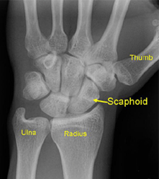 Scaphoid